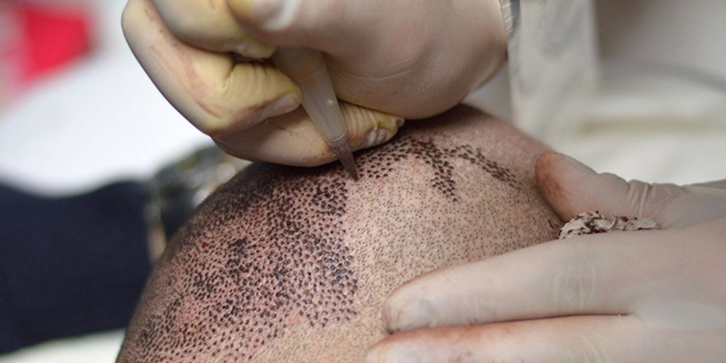 tricopigmentazione-non-e-un-tatuaggio